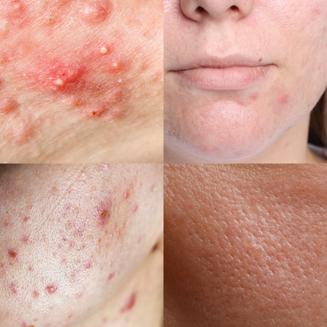 Acné en onzuivere huid: soorten, gradaties en de juiste start routine